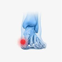 diabeticfoot9